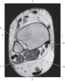 Refer to the figure below of an axial, T1-weighted MRI of the right ankle.    -Which arrow is pointing to the anterior tibiofibular ligament? A)  A B)  B C)  C D)  D