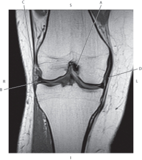Question refer to the figure below of a coronal, T1-weighted MRI of the right knee.    -Which arrow is pointing to the posterior cruciate ligament? A)  A B)  B C)  C D)  D