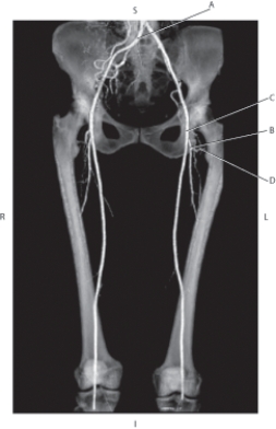 Refer to the figure below.    -Which arrow is pointing to the common iliac artery? A)  A B)  B C)  C D)  D