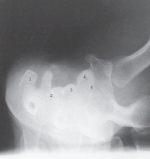 This projection is performed to rule out:   A) median nerve impingement. B) calcification in carpal sulcus. C) carpal tunnel syndrome. D) all of the above.
