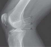 Which of the labeled structures is the lateral condyle of the femur?   A) A B) B C) C D) D E) E