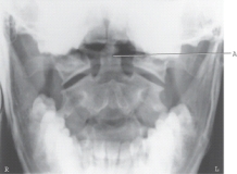 The structure labeled A, which should be well demonstrated on this projection, is the:   A) pedicle. B) lamina. C) odontoid process. D) inferior articular process.