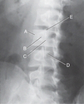 <strong>Which aspect of the Scottie dog is the pedicle? </strong> A)A B)B C)C D)D
