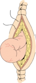 <strong>The nurse is changing the abdominal surgical dressing of an elderly patient who has developed pneumonia and a cough. Upon removing the dressing, the nurse notes the situation pictured above. What should be the nurse's intervention?    Select all that apply.</strong> A)Place saline moistened sterile dressing over the incision. B)Notify the patient's surgeon of the occurrence. C)Don sterile gloves and insert the loop of bowel back into the abdomen. D)Document the presence of a dehiscence in the medical record. E)Replace the dressing and ask the oncoming shift to advise the physician about the situation when rounds are made. <div style=padding-top: 35px> 