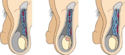 The nurse is caring for a patient with a hydrocele. Which diagram should the nurse use to explain this disorder to the patient? Mark an X on the appropriate image.
