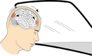 During a motor vehicle accident, a patient suffered multiple injuries of the brain. Place an X over the area where the countercoup injury would occur.   