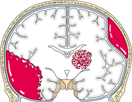 A patient has suffered a closed head injury due to a car accident. Place an  X  over the area that suggests the presence of a subdural hematoma.   