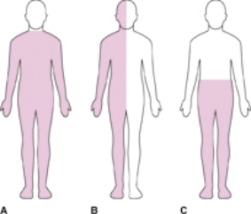 The nurse is caring for a patient with hemiplegia after experiencing a stroke. Which body areas should the nurse expect to be affected by the stroke? Mark an X on the body diagram below that depicts hemiplegia.  <div style=padding-top: 35px> 