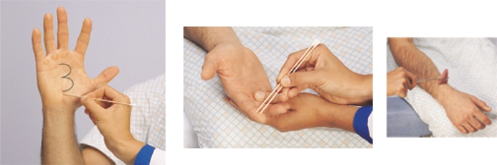 The nurse is conducting a neurological assessment of a patient. Place an  X  on the technique the nurse should use to test for graphesthesia.   