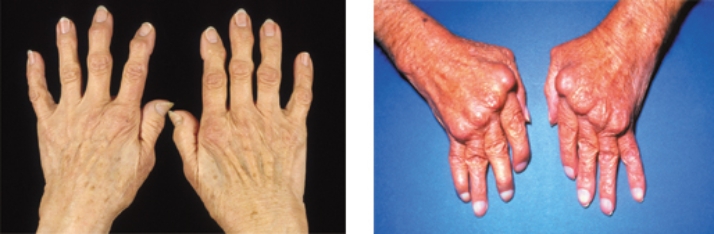 The nurse is assessing a patient with osteoarthritis. Which photograph demonstrates the most likely presentation of the patient's hands?      <div style=padding-top: 35px> 