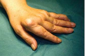 The nurse is assessing a patient with osteoarthritis. Which photograph demonstrates the most likely presentation of the patient's hands?      <div style=padding-top: 35px> 