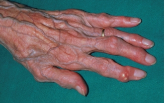 The nurse is assessing a patient with osteoarthritis. Which photograph demonstrates the most likely presentation of the patient's hands?      <div style=padding-top: 35px> 
