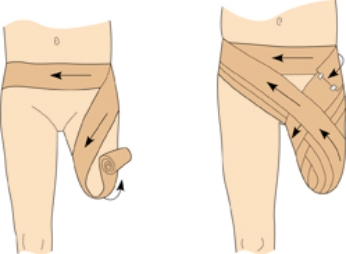 <strong>The nurse is changing a patient's stump dressing. The nurse understands that proper technique must be used for the above-the-knee amputation. Which technique should the nurse use for this dressing change?  </strong> A) figure-eight bandage B) compression bandaging technique C) splinting D) bivalving <div style=padding-top: 35px> 
