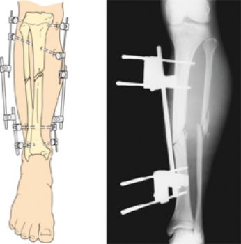 The patient has a fracture of the right tibia and fibula. The orthopedic surgeon decides to surgically correct the fractures with the device in the figure. What type of device is being used?   A)  internal fixation device B)  external fixation device C)  Buck's traction D)  wiring