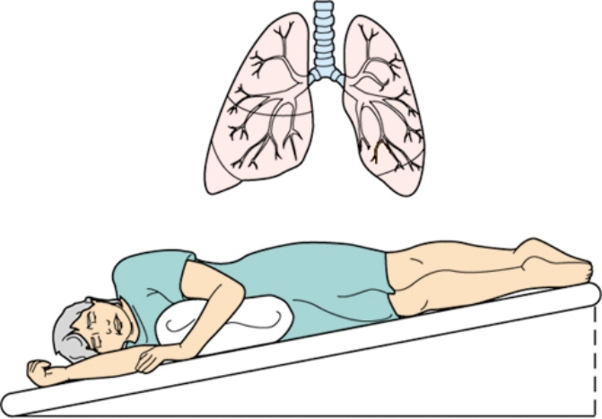 The nurse places a patient in the position illustrated. Which lung area is the nurse focusing for postural drainage? Indicate with an  X  on the diagram.   