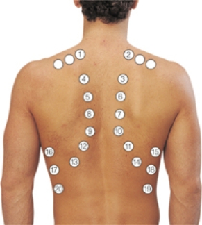 A trauma patient has no lung sounds in the oblique fissure, lower-left lobe, and base of the lung. Place an  X  over the area(s) the nurse is assessing.   