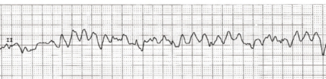 The nurse sees this rhythm on a patient's cardiac monitor. For which rhythm should the nurse begin care?   A)  ventricular fibrillation B)  atrial flutter C)  sinus tachycardia D)  ventricular tachycardia