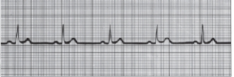 Type: MCSA Graphic A patient in the coronary care unit has the following cardiac rhythm:   What action should the nurse take when caring for this patient? A)  Prepare to defibrillate. B)  Monitor for any changes. C)  Notify the healthcare provider. D)  Administer a dose of sublingual nitroglycerin.