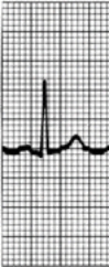 The nurse is reviewing the parts of a cardiac rhythm tracing with a patient scheduled for pacemaker insertion. Which wave should the nurse identify as the T wave? Place an X at the location of the T wave in the diagram.