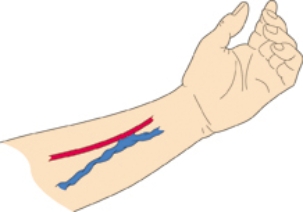 The nurse is assessing a patient with this type of device in the arm. For what should the nurse assess this patient?   A)  a bruit upon auscultation B)  a thrill upon auscultation C)  a bruit upon palpation D)  a thrill upon inspection