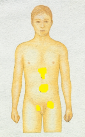 The nurse is conducting a physical assessment and wants to palpate for hernias. Place an  X  over the location on the diagram where the nurse should palpate for the most common type of hernia.   