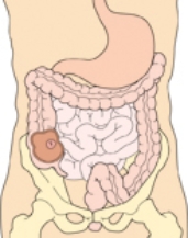 The nurse is planning to review the pathophysiology of ulcerative colitis with a patient who is newly diagnosed with the disorder. Place an  X  on the diagram below which indicates the most common site of ulcerative colitis.   