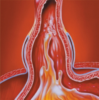 <strong>The nurse is caring for a patient with the health problem illustrated in the diagram. For which health problem should the nurse plan care?  </strong> A) hiatal hernia B) diaphragmatic hernia C) esophageal ulcer D) stomach ulcer <div style=padding-top: 35px> 