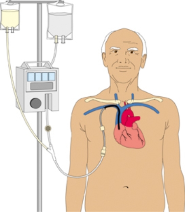 The nurse is assisting with the placement of a central subclavian access device in a patient with malnutrition. Using the diagram, indicate where the nurse would expect the catheter to be placed in this patient.   