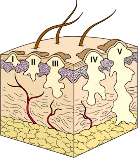 The nurse is caring for a patient with a superficial partial-thickness burn. Place an X over the section of the diagram that represents the depth of this injury.  <div style=padding-top: 35px> 