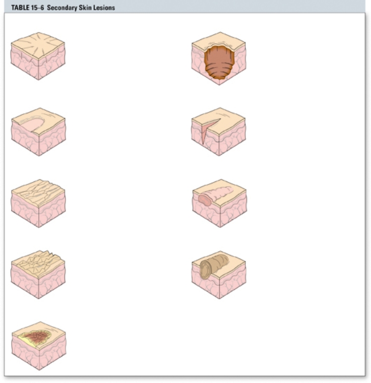 The nurse is caring for a patient with a skin fissure. Place an  X  over the diagram that represents a skin fissure.   