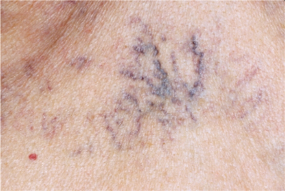 The nurse notes the presence of this lesion on the patient's anterior chest. How should the nurse document this finding in the medical record?   A)  purpura B)  ecchymosis C)  venous star D)  spider angioma