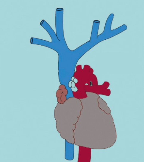Place an  X  at the site where a mediastinal or thoracic tumor causing superior vena cava syndrome is located.   