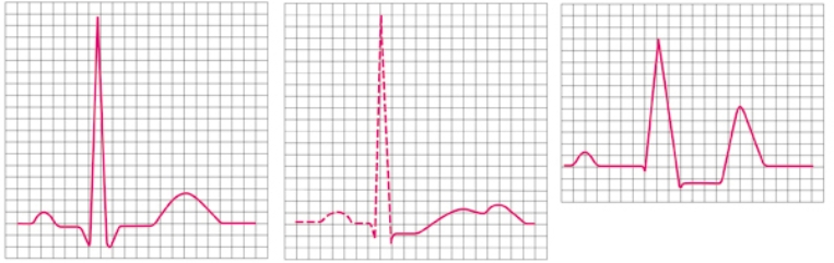 The nurse is caring for a patient with serum potassium of 5.9 mEq/L. Which electrocardiogram tracing should the nurse expect to observe in this patient? Place an X on the tracing that is most likely to represent the patient's cardiac electrical activity.  <div style=padding-top: 35px> 
