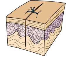 <strong>The patient who had an emergency abdominal surgery looks at his incision on the first postoperative day and says, I sure hope this doesn't leave much of a scar. Is there some type of medicine or ointment I can put on it? What should the nurse consider prior to responding to that comment? </strong> A) This incision will heal by primary intention and will probably leave only a hairline scar. B) This incision will fill in with granulation tissue and leave a moderately big scar despite any medication applied. C) This incision was done in an emergent fashion but continuous application of steroid creams will prevent scarring. D) This incision will have to be reclosed later and will leave a large scar unless a topical antibiotic is used continuously.