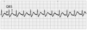 A patient who is complaining of a  racing  heart and nervousness comes to the emergency department. The patient's blood pressure (BP)  is 102/68. The nurse places the patient on a cardiac monitor and obtains the following ECG tracing.   Which action should the nurse take next? A)  Have the patient perform the Valsalva maneuver. B)  Prepare to administer b-blocker medication to slow the heart rate. C)  Get ready to perform electrical cardioversion. D)  Obtain further information about possible causes for the heart rate.