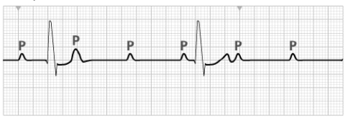 A patient experiences dizziness and shortness of breath for several days. During cardiac monitoring in the ED, the nurse obtains the following ECG tracing.   The nurse interprets this cardiac rhythm as A)  third-degree AV block. B)  sinus rhythm with premature atrial contractions (PACs) . C)  sinus rhythm with PVCs. D)  junctional escape rhythm.