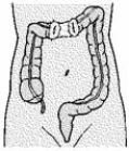 A patient with a gunshot wound to the abdomen undergoes surgery, and a colostomy is formed as illustrated. The nurse explains to the patient that   A)  this type of colostomy is usually temporary. B)  soft, formed stool can be expected as drainage. C)  the drainage is liquid at this site but less odorous than at higher sites. D)  colostomy irrigations can help regulate the drainage from the proximal stoma.