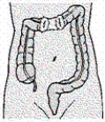<strong>A patient with a gunshot wound to the abdomen undergoes surgery, and a colostomy is formed as illustrated. Which information will be included in patient teaching?  </strong> A) This type of colostomy is usually temporary. B) Soft, formed stool can be expected as drainage. C) Stool will be expelled from both ostomy stomas. D) Irrigations can regulate drainage from the stomas. <div style=padding-top: 35px> 