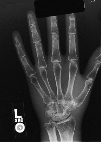 What projection and anatomy of interest are demonstrated in Figure 19-3?   A)  PA projection of the hand B)  AP projection of the thumb C)  Lateral projection of the hand D)  AP projection of the hand