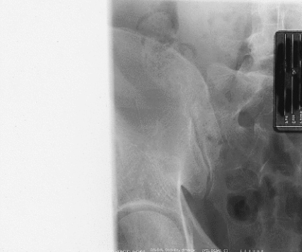 Which of the following errors is evident in Figure 19-5?   A)  There is rotation of the anatomy of interest. B)  CR and IR were not aligned. C)  The image is too dark. D)  There is no error evident in Figure 19-5.