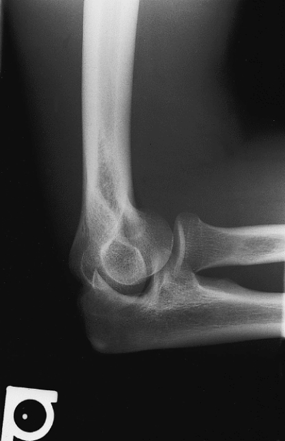 What projection and anatomy of interest are demonstrated in Figure 19-6?   A)  AP projection of the forearm B)  AP projection of the elbow C)  Lateral projection of the forearm D)  Lateral projection of the elbow