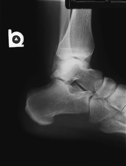 What is wrong with Figure 19-7?   A)  Anatomy is rotated to the left. B)  A radiographic marker is not present. C)  There is too much density on the image. D)  The image contrast is too high.