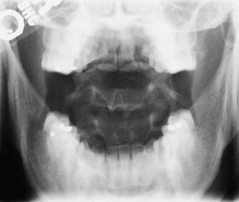 What is wrong with Figure 19-8?   A)  There is too much density on the image. B)  The anatomy of interest is rotated. C)  Image contrast is too low. D)  An artifact is present on the image.