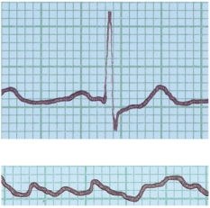 <strong>In the figure shown here, the top ECG shown is normal. What condition does the bottom ECG indicate? </strong> A) ventricular fibrillation B) a heart murmur C) hypertension D) stroke E) angina pectoris