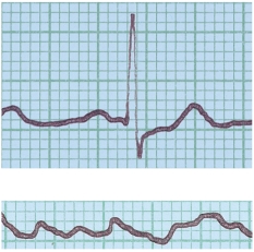 <strong>In the figure shown here,the top ECG shown is normal.What condition does the bottom ECG indicate?  </strong> A) ventricular fibrillation B) a heart murmur C) hypertension D) stroke E) angina pectoris <div style=padding-top: 35px> 