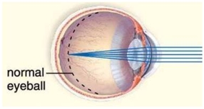 In the abnormal eyeball pictured here,the size of a normal eye is noted with a dotted line.This type of abnormality results in   A) farsightedness. B) astigmatism. C) nearsightedness. D) cataracts. E) glaucoma.