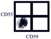 A flow cytometry analysis was done as shown in the figure with the gate set on red blood cells. What is the most likely interpretation of the analysis?   A) The red cells were all lysed in the preparation. B) The gate is contaminated with white blood cells. C) The patient may have a glucose- 6- phosphate dehydrogenase deficiency. D) The patient may have paroxysmal nocturnal hemoglobinuria. E) The reticulocyte population is elevated.