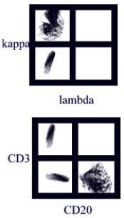 A patient presented with a very high white blood count with 90% lymphocytes. Flow cytometry analysis was done with the gate set on the lymphocytes. What is the best interpretation of the results below?   A) B cell leukemia B) Granulocytic leukemia C) T cell leukemia D) Leukocytosis due to infection