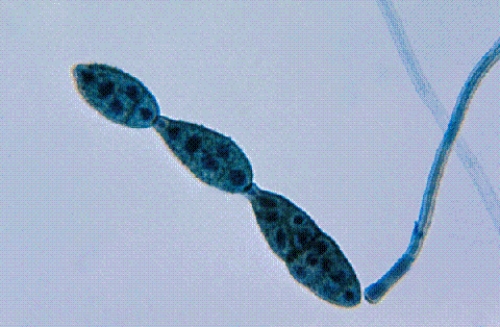Identify the following:   A)  Candida albicans B)  Alternaria spp. C)  Mucor spp. D)  Pseudoallescheria boydii