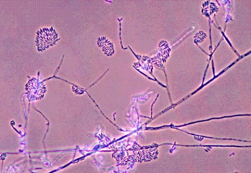 Identify the following:   A)  Sporothrix schenckii B)  Fusarium spp. C)  Mucor spp. D)  Geotrichum spp.